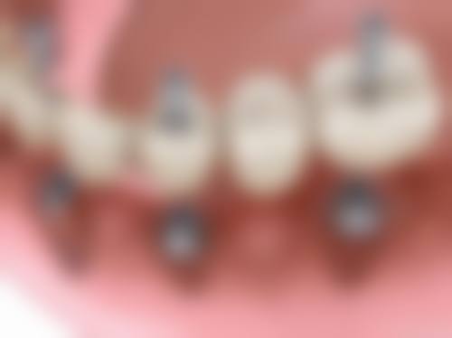 西安双宝口腔的特色技术对西安双宝口腔刘树春医生韩国登腾种植牙3880元起项目有帮助吗？