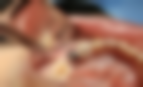 西安双宝口腔的种牙搭桥方案与西安双宝口腔刘树春医生韩国登腾种植牙3880元起有什么关系？