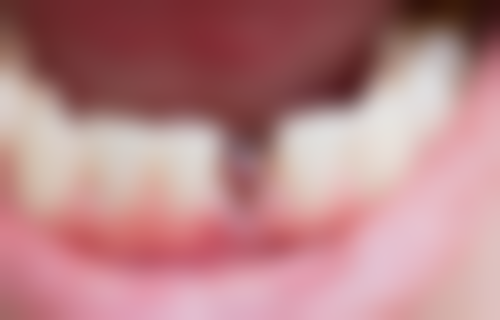 韩国登腾种植牙3880元起有什么优势？西安双宝口腔刘树春医生做韩国登腾种植牙3880元起成效如何？