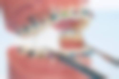 韩国进口种植牙存在什么缺点？