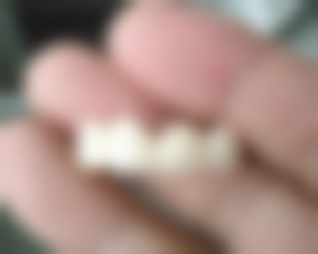 如果不符合门牙种植适应证，还有其他办法修复门牙缺失吗？