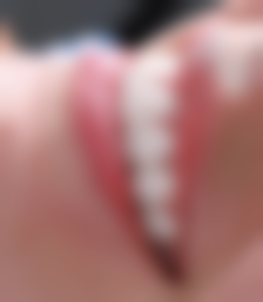 7岁牙齿坏了需要补牙吗？一般要补，利于恒牙萌出且能防邻牙移位和龋齿！ 