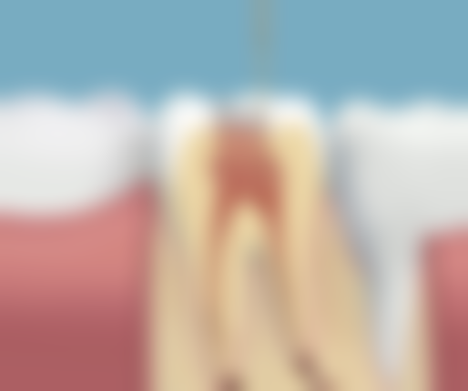 下巴前突但不是地包天，戴牙套能矫正吗？