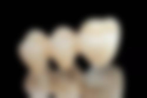 保留牙根装假牙有什么好处呢？