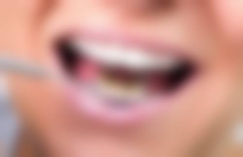 烤瓷牙能做ct和磁共振吗？含金属烤瓷牙有影响，全瓷烤瓷牙一般不受限！ 