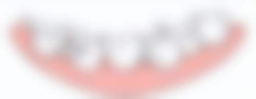 固定桥适用于什么情况,长期会产生什么影响呢?