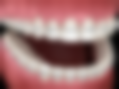 选择种植牙技术时，国内产地重要吗？