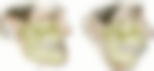 拔牙后种植牙有哪些术后注意事项?