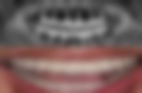 拔牙后该怎么护理来避免长时间疼痛呢?