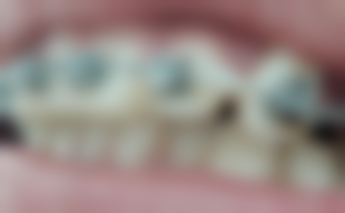 诺贝尔种植牙不同型号在质量上有什么特点?