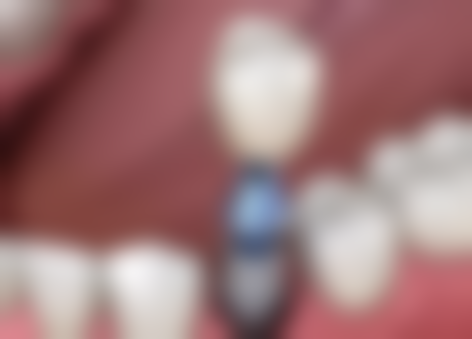 拔牙之后一定要牙齿种植吗？其实并非绝对，还有活动义齿、固定桥修复等多种选择！ 