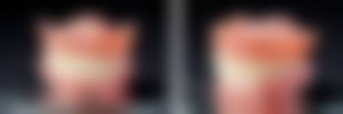 恒牙期地包天的修复时间和哪些情况有关呢？