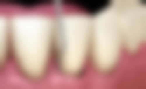 生理期第六天能拔牙吗？了解凝血状况与风险，为你揭晓能否拔牙的答案！ 