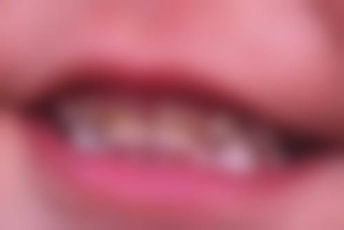 镶牙和种植牙在成效与维护方面有什么差异？