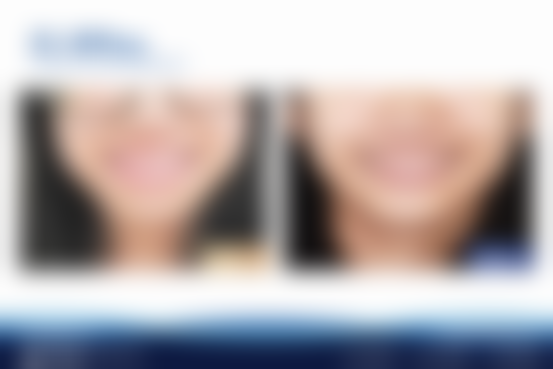 广州天河柏德口腔门诊部王丽艳医生做恒牙期反合的正畸正颜联合矫治，治疗过程是怎样的呢？