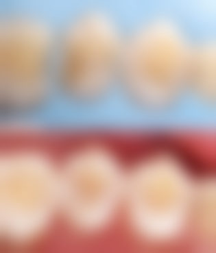 一般全瓷牙保修多久？通常1 - 5年，具体时长受品牌、医院等因素影响 