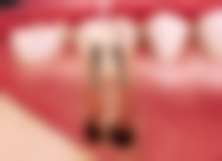 在创伤程度方面，微创拔牙和传统拔牙有什么不同？