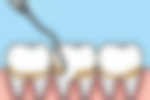 矫正方案会如何影响拔智齿后做矫正的时间呢？