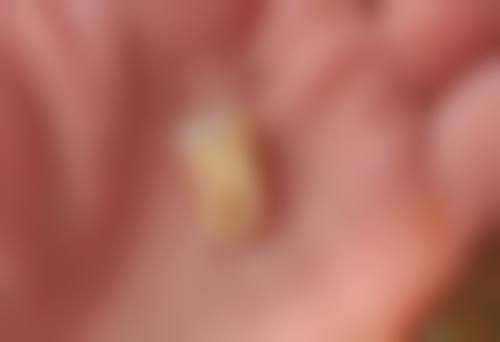 有哪些物理方法可以缓解拔牙后吃东西的疼痛呢？