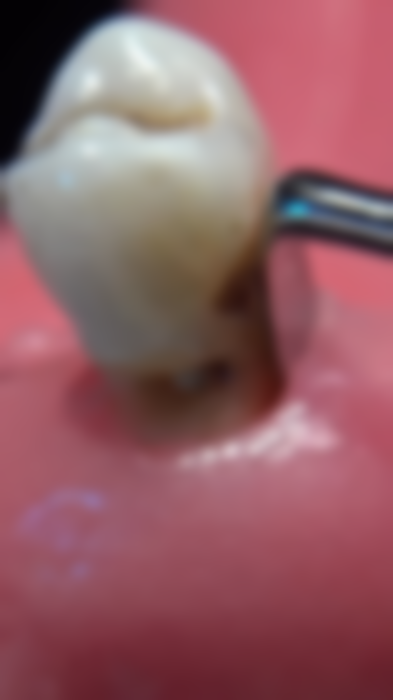 牙齿有洞就一定能直接补牙吗？