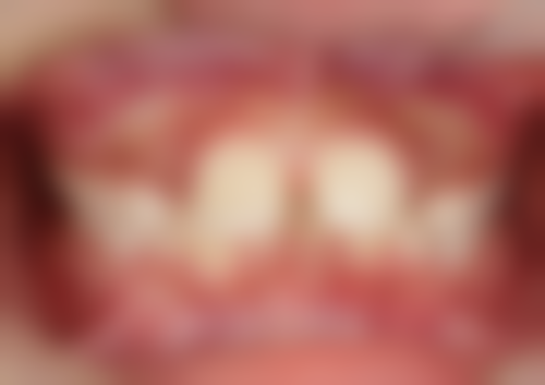 东莞口腔医院做二次根管治疗怎么样？