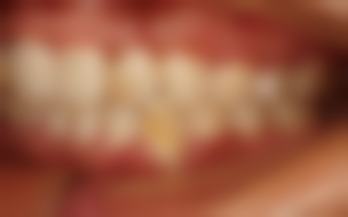 牙龈萎缩导致的缝隙如何处理？