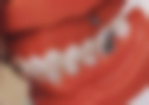 牙齿矫正会引发牙龈红肿或萎缩吗？