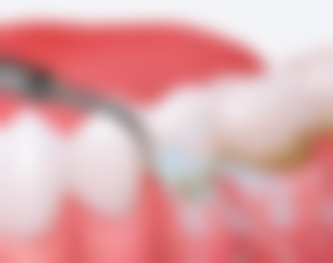 牙齿矫正对牙齿的伤害有哪些？是否会导致牙齿松动、影响牙槽骨高度和牙髓健康？ 