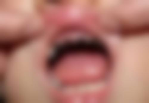 成年期正畸什么时候做比较好？