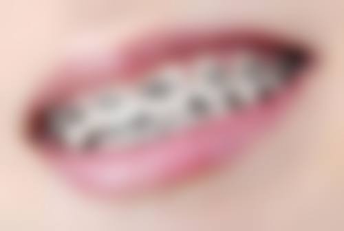 根管治疗后有哪些补牙方案呢？