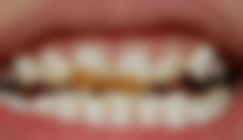 根管治疗还有哪些其他相关说明?