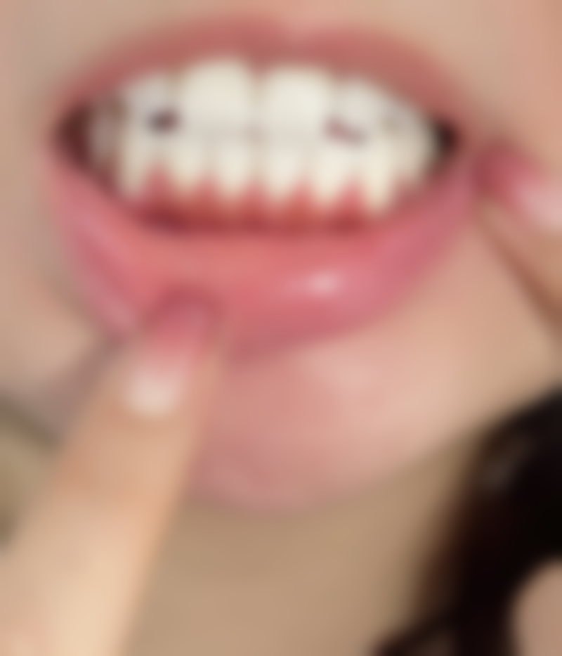 除了牙胶尖和根管封闭剂,还有其他可用于根管治疗恒久封闭的材料吗?