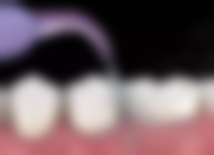 四十多岁可以洗牙吗？答案是可以，洗牙能有效清除牙菌斑和牙结石，有益口腔健康！ 