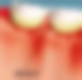 漱口水能去除牙垢吗？它是如何发挥作用的？