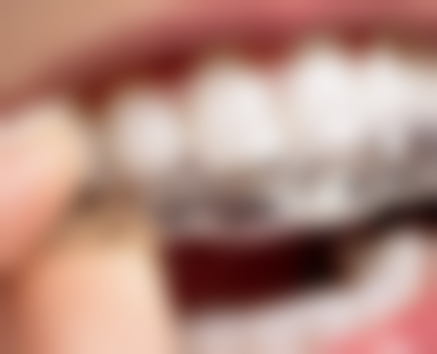 除了主流品牌，还有哪些热门种植牙品牌呢？