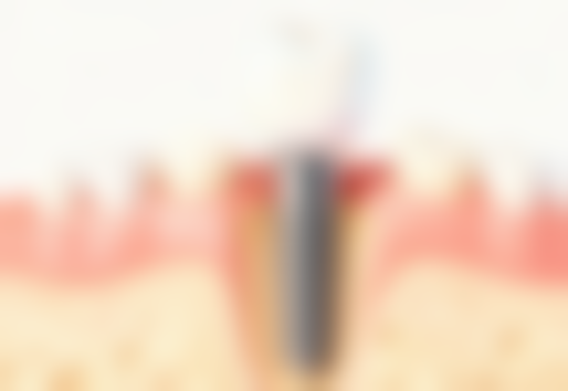 装置矫治器时会有疼痛吗？