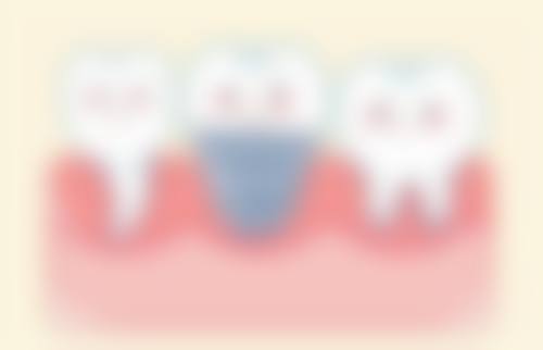 南充美佳口腔诊所苏怀风医生种植牙技术怎么样？