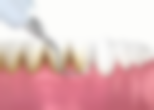 龅牙矫正拔牙有危害吗？专业操作下一般无危害，还能助牙齿排列更整齐！ 