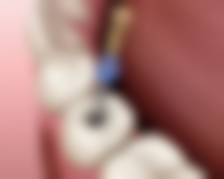 拔牙后运动还有哪些注意事项？