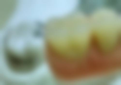 放疗后拔牙有哪些主要风险？