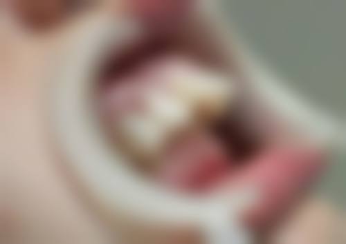 未及时补牙会有什么危害？