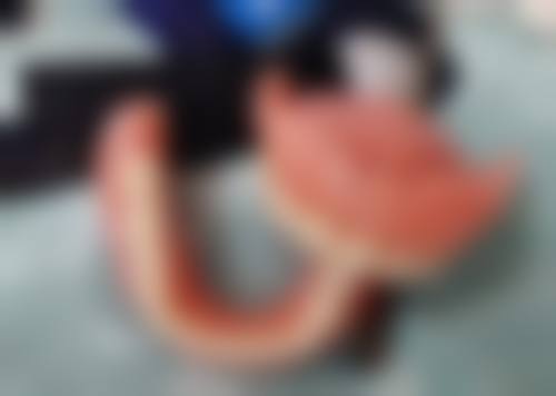 吉林长春高新金麦口腔马欣医生微创种植牙技术怎么样?